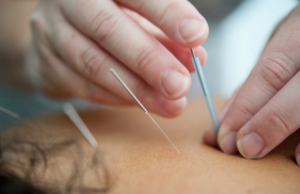 management, pain reduction without opioids, ways to relieve pain without opioids, non opioid pain medication,
nonnarcotic pain meds, acupuncture for chronic pain